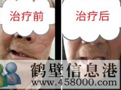 鹤壁面瘫后遗症的康复理疗_鹤壁陈氏面瘫康复馆